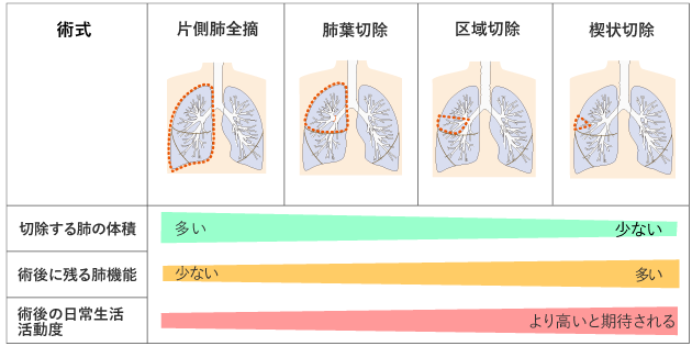 図５　肺がんの手術と術後の状態の図