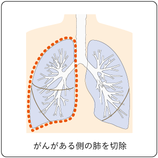 図６　片側肺全摘手術の切除範囲の図