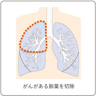 図７　肺葉切除術の切除範囲の図