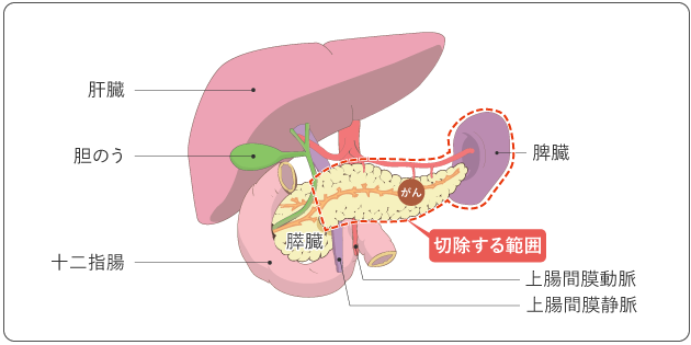 図６　膵体尾部切除術で切除する範囲の図