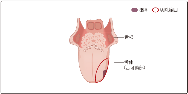 図３　舌部分切除術の切除範囲