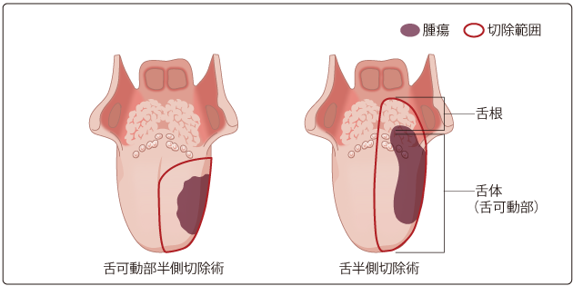 図４　舌半側切除術の切除範囲