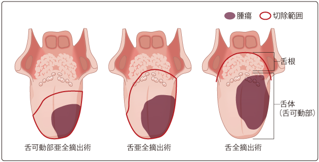 図５　舌亜全摘出術／舌全摘出術の切除範囲