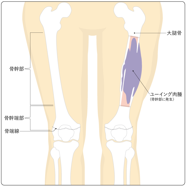 図１　大腿骨の骨幹部に発生したユーイング肉腫