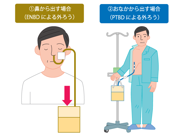 図６　外ろうによる胆汁の回収方法の図