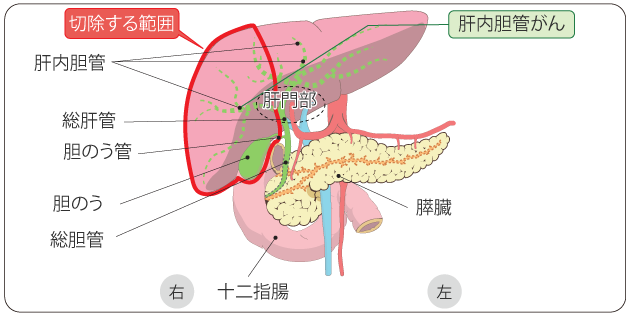 図７　肝内胆管がんの切除範囲の一例（右側肝切除）の図