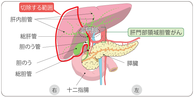 図８　肝門部領域胆管がんの切除範囲の一例（右肝切除・肝外胆管切除）の図