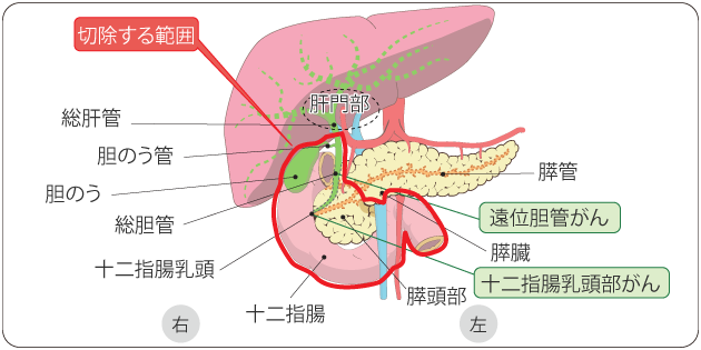 図９ 膵頭十二指腸切の範囲の図
