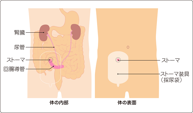 図７　回腸導管造設術