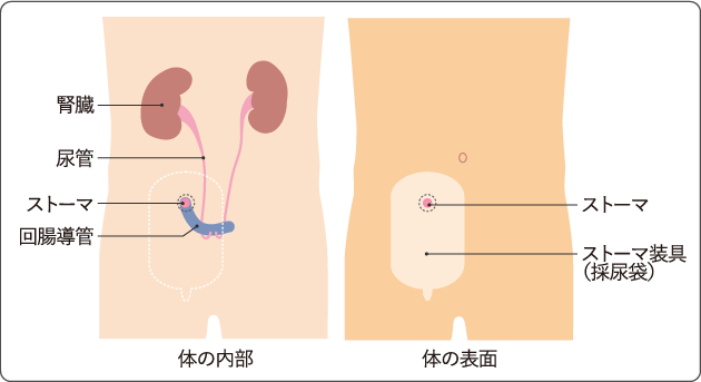 図７　回腸導管造設術