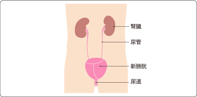 図８　自排尿型新膀胱造設術