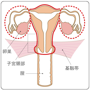 図６　単純子宮全摘出術の範囲の図