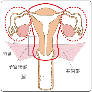 図７　準広汎子宮全摘出術の範囲の図