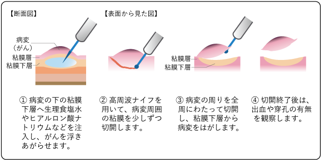 図９　内視鏡的粘膜切除術（EMR）の図