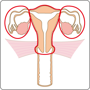 図４　単純子宮全摘出術と両側付属器摘出術の範囲の図