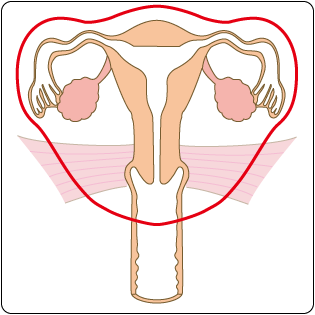 図６　広汎子宮全摘出術の範囲の図