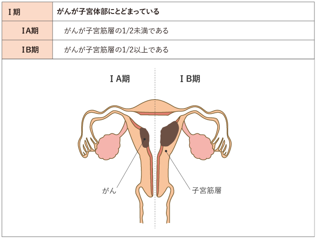 表１　子宮体がんの手術進行期分類（日産婦2011、FIGO2008）の表