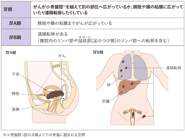 表１　子宮体がんの進行期分類（日産婦2011、FIGO2008）
