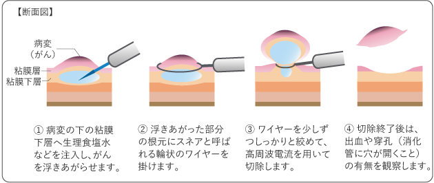 図７　内視鏡的粘膜下層剥離術（ESD）の図