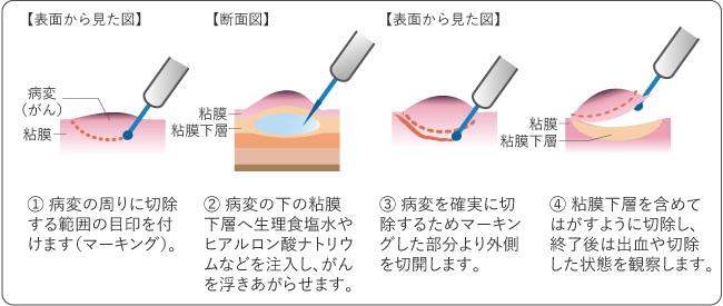 図８　内視鏡的粘膜下層剥離術（ESD）の図