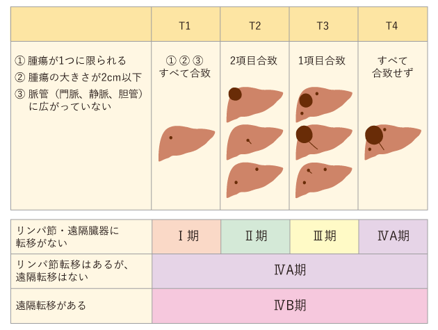 表3　肝細胞がんの病期分類（日本肝癌研究会）