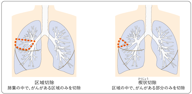 図８　片側肺全摘手術の切除範囲の図