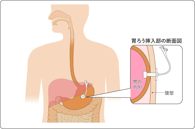 図4　胃ろう