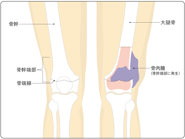 図１　大腿骨の骨幹端部に発生した骨肉腫