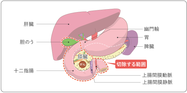 図４　幽門輪温存膵頭十二指腸切除術（PPPD）で切除する範囲の図