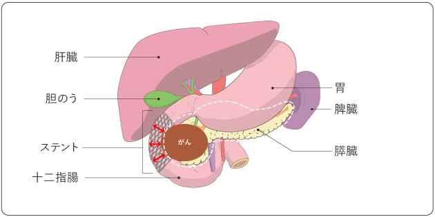 図７　胃空腸吻合バイパスと胆管空腸吻合バイパスの図