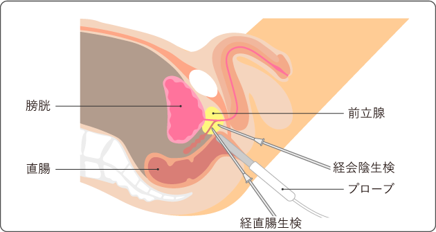 prostate_fig02