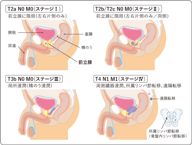 prostate_fig03