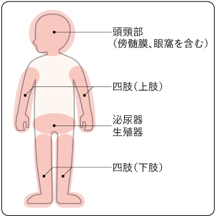 図３　横紋筋肉腫が発生しやすい部位