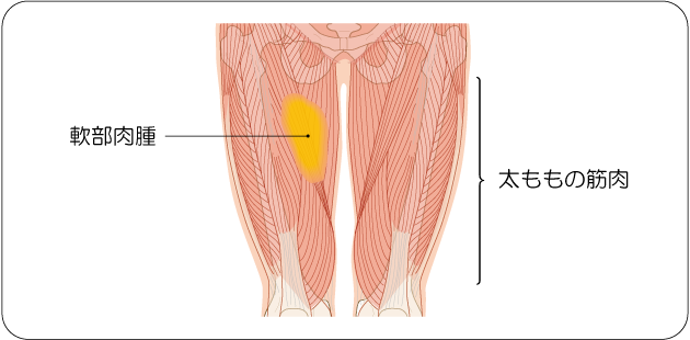 図１　太ももの筋肉にできる軟部肉腫の図