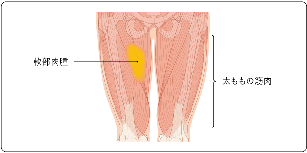 図１　太ももの筋肉に発生した軟部肉腫