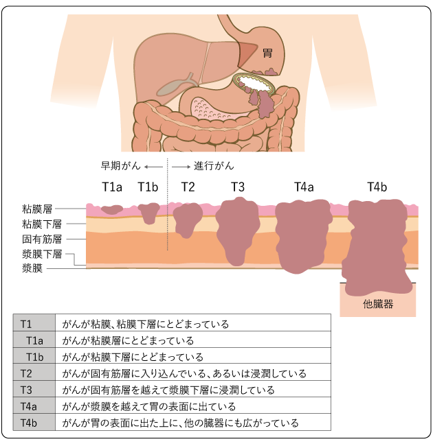 図５　胃がんのTカテゴリー（深達度）