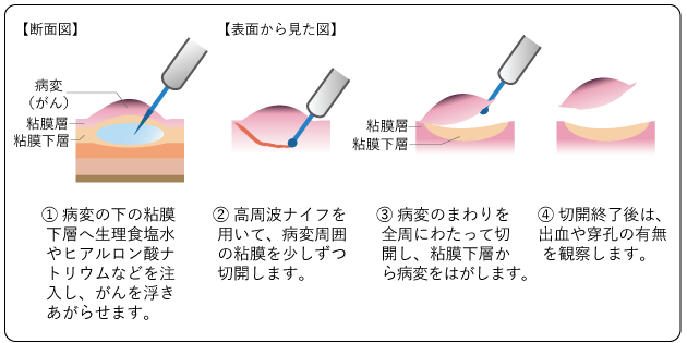 図８　内視鏡的粘膜下層剥離術（ESD）