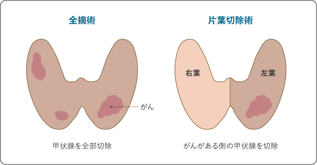 図６　甲状腺がんの主な手術の方法