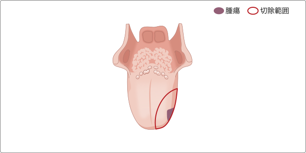 図３　舌部分切除術の切除範囲の図