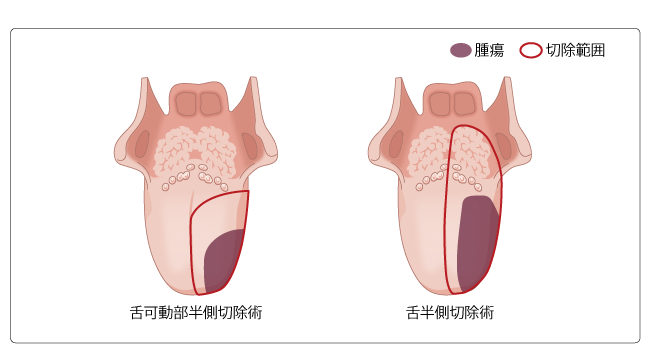 図４　舌半側切除術の切除範囲の図