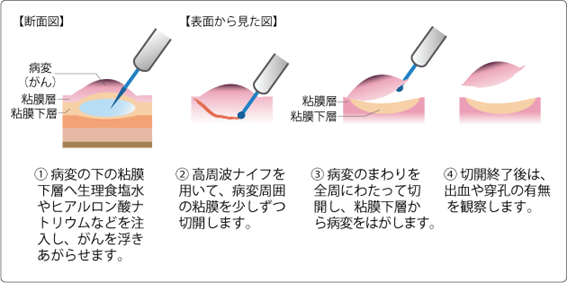 図2　内視鏡的粘膜下層剥離術（ESD）