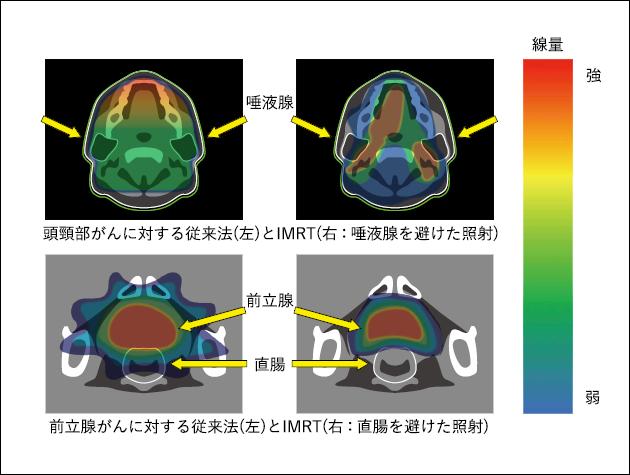 図７　強度変調放射線治療（IMRT）の照射イメージの図