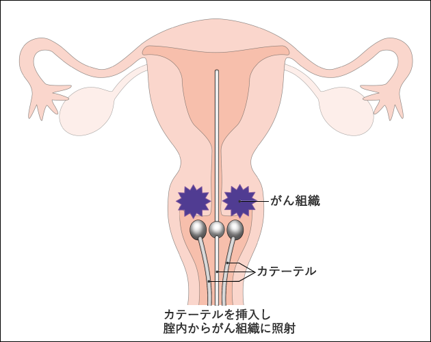 図１２　子宮頸がんへの密封小線源治療の例の図