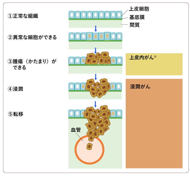 図２　がんの発生と進行