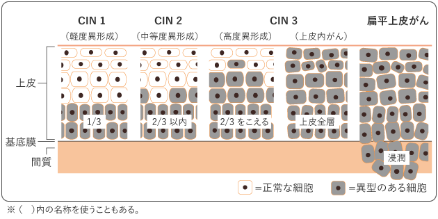 図2 扁平上皮がんの発生・進行のしかた(イメージ)の図