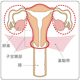 図6 単純子宮全摘出術の範囲の図