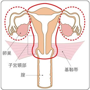 図7 準広汎子宮全摘出術の範囲の図
