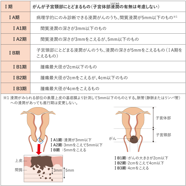 表1 子宮頸がんの臨床進行期分類(日産婦2020、FIGO 2018) Ⅰ期