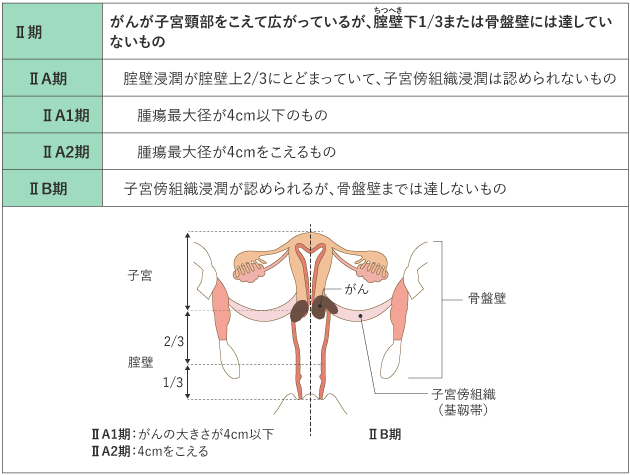 表1 子宮頸がんの臨床進行期分類(日産婦2020、FIGO 2018) Ⅱ期