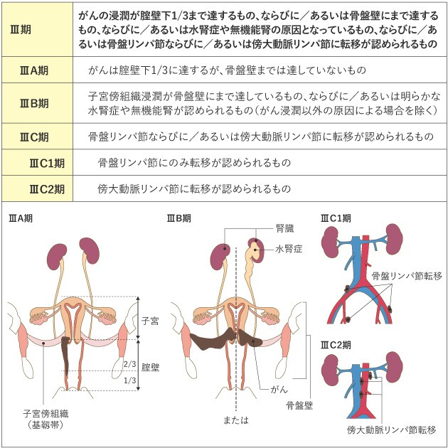 表1 子宮頸がんの臨床進行期分類(日産婦2020、FIGO 2018) Ⅲ期